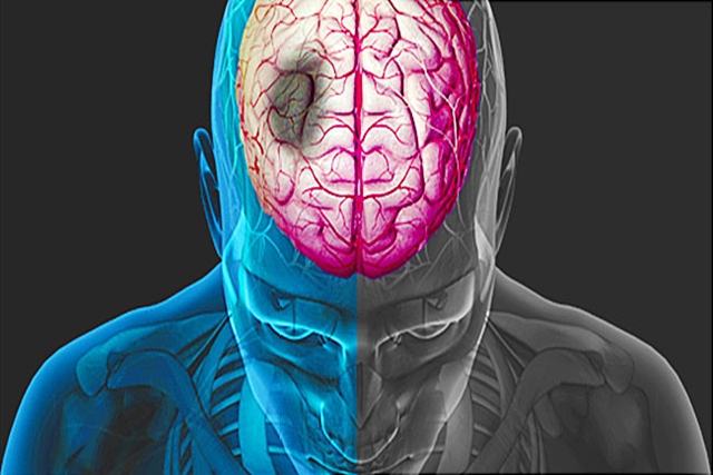 Yuk Kenali 6 Gejala Stroke