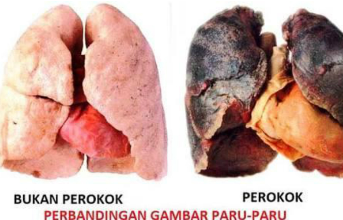 Paru_paru_1.jpg Kanker paru-paru